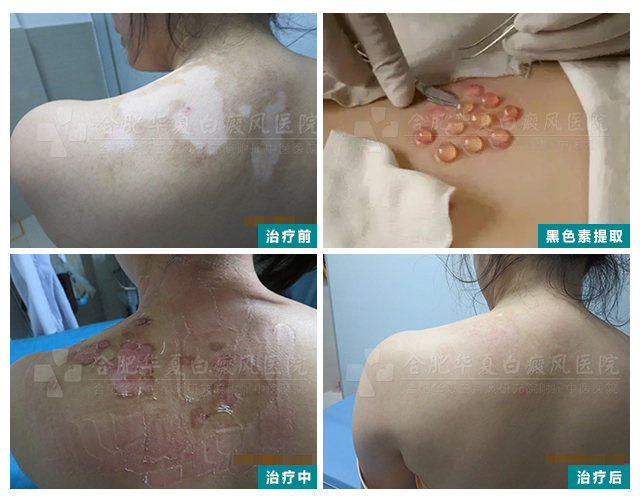 黑色素案例2.jpg
